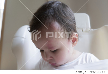 顔に虫刺され跡が沢山ある2歳の男の子の顔アップ 99230243