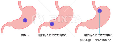 胃がんの腫瘍ができる場所を示したイラスト 99240672