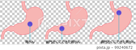 胃がんの腫瘍ができる場所を示したイラスト 99240672