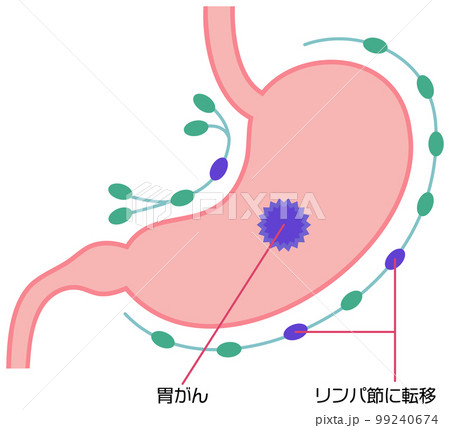 リンパ節に移転した胃がんのイラスト 99240674