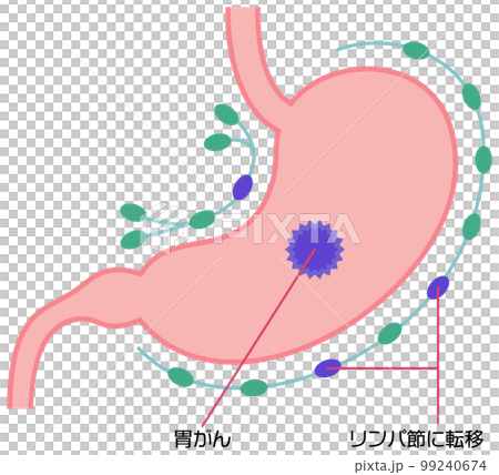 リンパ節に移転した胃がんのイラスト 99240674