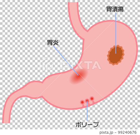 Illustration showing gastritis, stomach ulcer and polyp Illustration showing gastritis, stomach ulcer and polyp 99240676