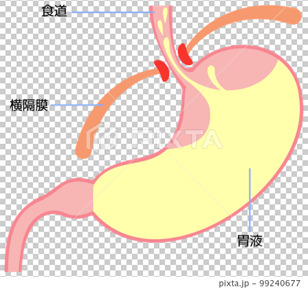 Illustration of stomach causing reflux esophagitis Illustration of stomach causing reflux esophagitis 99240677