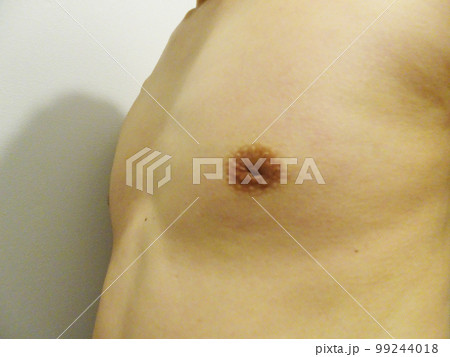 男性の陥没乳頭 99244018