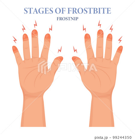 Frozen hands in different stages. Medical frostbite. Stages of frostbite of fingers. Skin burn symptom. Medical healthcare concept. Vector 99244350