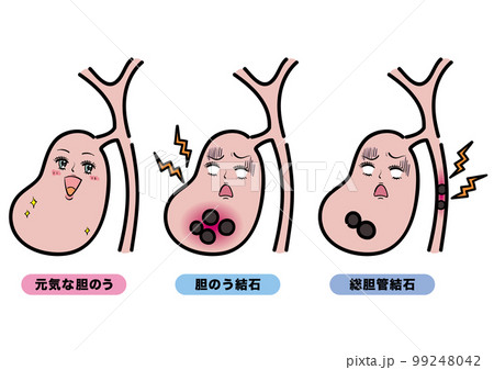 元気な胆のう・胆石・総胆管結石のセット 99248042