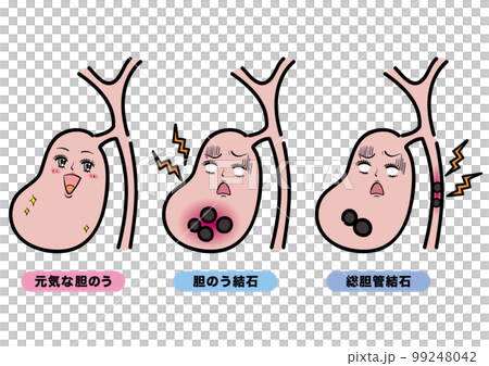 一套健康的膽囊、膽結石和膽總管結石 一套健康的膽囊、膽結石和膽總管結石 99248042