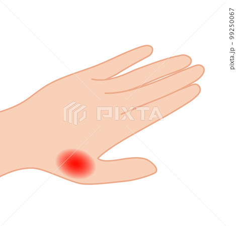 手の親指の関節が炎症しているイラスト 99250067
