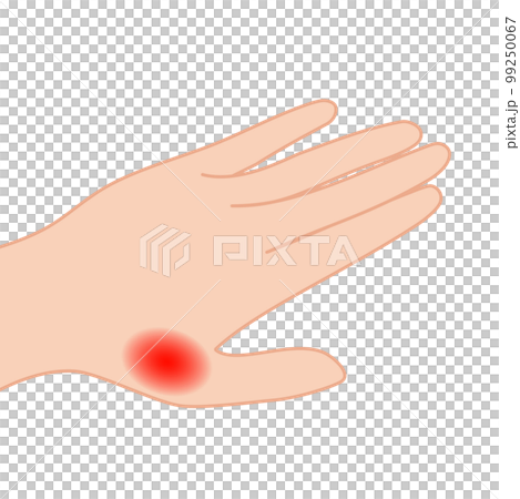 手の親指の関節が炎症しているイラスト 99250067