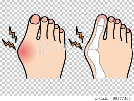 拇外翻足 拇外翻足 99277362