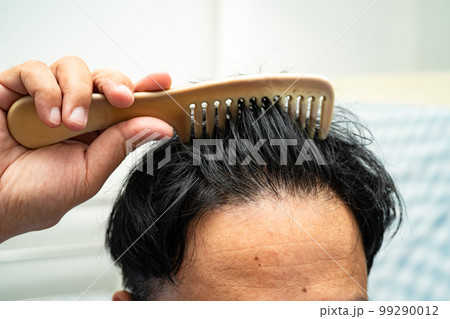 Bald at front of head and begin no loss hair glabrous of mature Asian business smart active office man. 99290012
