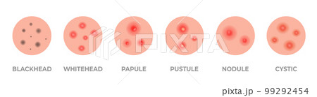 Acne types set. Skin pimples, blackheads and face comedones. Acne skin types - blackheads, whiteheads, papules, pustules, cystic and nodular 99292454