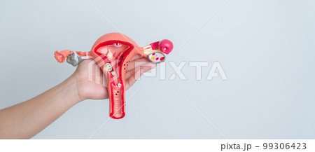 Woman holding Uterus and Ovaries model. Ovarian and Cervical cancer, Cervix disorder, Endometriosis, Hysterectomy, Uterine fibroids, Reproductive system and Pregnancy concept 99306423