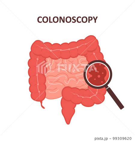 Colonoscopy concept. Intestine exam and treatment. Colon polypectomy procedure. Prevention of cancer. Vector illustration in flat cartoon style 99309620