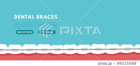 Teeth braces banner. Orthodontic problem, smile with brackets, retainer. Flat vector isolated illustration 99325098