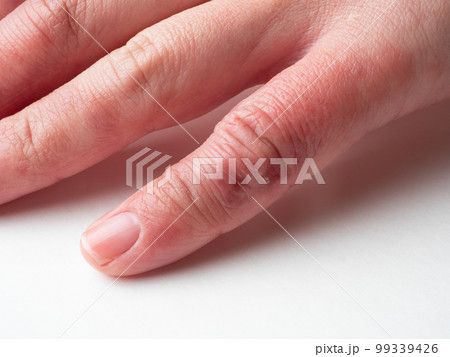 しもやけ・あかぎれで腫れた女性の手 しもやけ・あかぎれで腫れた女性の手 99339426