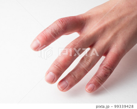しもやけ・あかぎれで腫れた女性の手 しもやけ・あかぎれで腫れた女性の手 99339428