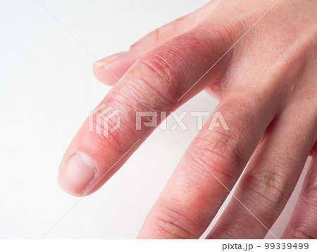 しもやけ・あかぎれで腫れた女性の手 99339499