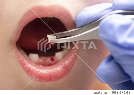 Removal of a milk tooth. The doctor pulled out a tooth from a child with tweezers. Extraction of a child's tooth with a dental instrument. Removal of a milk tooth. The doctor pulled out a tooth from a child with tweezers. Extraction of a child's tooth with a dental instrument. 99347148