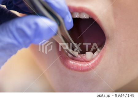 Children's teeth. The doctor extracts a child's tooth. Milk teeth in a child, close-up 99347149