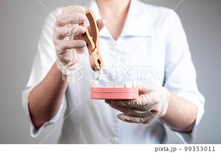 Dentist pulling tooth with forceps out of jaw model. Teeth extraction caused by trauma, decay, dental disease. Stomatology, health care concept. Dentist pulling tooth with forceps out of jaw model. Teeth extraction caused by trauma, decay, dental disease. Stomatology, health care concept. 99353011