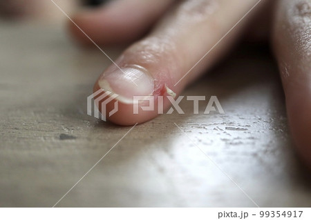 ささくれ、さかむけ ささくれ、さかむけ 99354917