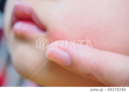 mother applying topical antihistamine cream at kid face with skin rash and allergy with red spot cause by mosquito bite 99370280