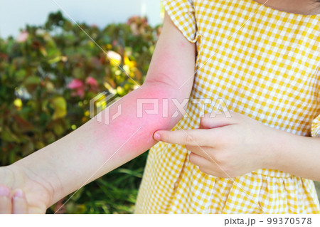 Little girl has skin rash allergy and itchy on her arm Little girl has skin rash allergy and itchy on her arm 99370578