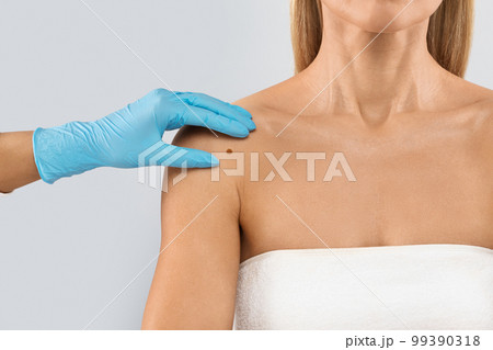 Doctor hand checking mole nevus on unrecognizable woman's shoulder 99390318