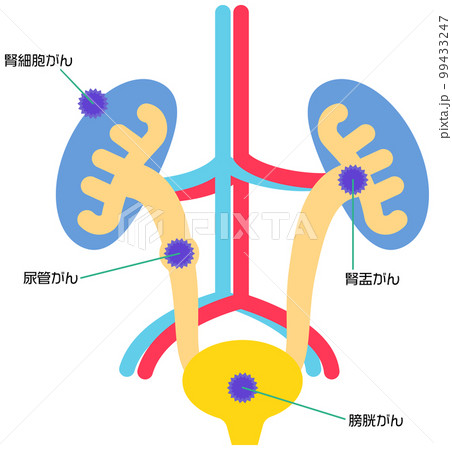 膀胱、腎臓周辺にできる癌の種類 99433247