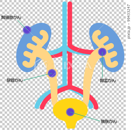 膀胱和腎臟周圍的癌症類型 99433247