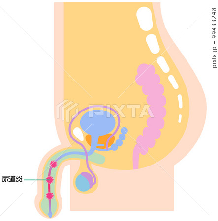 尿道炎を表したイラスト 99433248