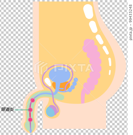 尿道炎を表したイラスト 99433248