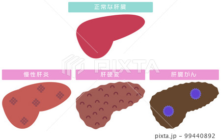 慢性肝炎から肝癌までを表したイラスト 慢性肝炎から肝癌までを表したイラスト 99440892