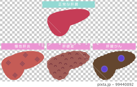 慢性肝炎から肝癌までを表したイラスト 慢性肝炎から肝癌までを表したイラスト 99440892