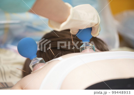 The doctor makes the patient acupuncture and vacuum massage. The doctor makes the patient acupuncture and vacuum massage. 99448933