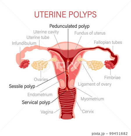 Types of uterine polyps. Diseases of the female reproductive system. Gynecology. Medical concept. Infographic banner. Vector 99451682