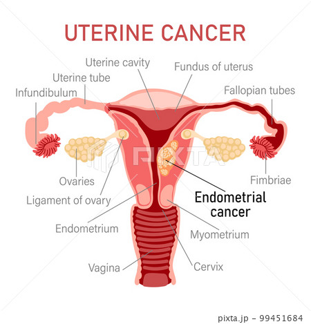 Uterine cancer. Diseases of the female reproductive system. Gynecology. Medical concept. Infographic banner. Vector 99451684