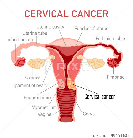 Cervical cancer. Diseases of the female reproductive system. Gynecology. Medical concept. Infographic banner. Vector Cervical cancer. Diseases of the female reproductive system. Gynecology. Medical concept. Infographic banner. Vector 99451685