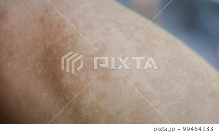 Macro part of the body is uneven pigmentation skin Macro part of the body is uneven pigmentation skin 99464133
