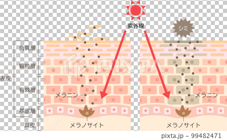 瑕疵的機制 皮膚橫截面 之前和之後 99482471