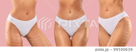 Young european ladies in bikini with perfect skin, slim body with lines for figure shaping or drainage massage Young european ladies in bikini with perfect skin, slim body with lines for figure shaping or drainage massage 99500639