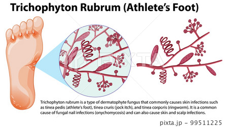 Trichophyton Rubrum fungal infection Trichophyton Rubrum fungal infection 99511225