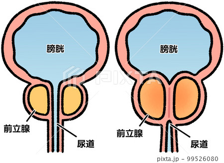 正常な前立腺と肥大した前立腺(名称あり) 99526080