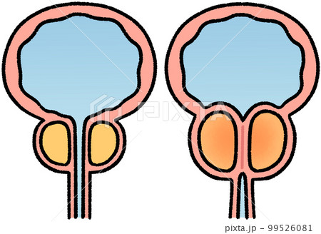 正常な前立腺と肥大した前立腺 99526081