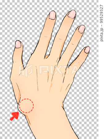 A hand with a ganglion above the wrist below the thumb 99529327