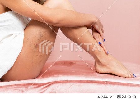 A slender woman is sitting on a pink velvet sofa, showing vascular inflammation on her thigh. Side view. The concept of varicose veins and varicosity A slender woman is sitting on a pink velvet sofa, showing vascular inflammation on her thigh. Side view. The concept of varicose veins and varicosity 99534548