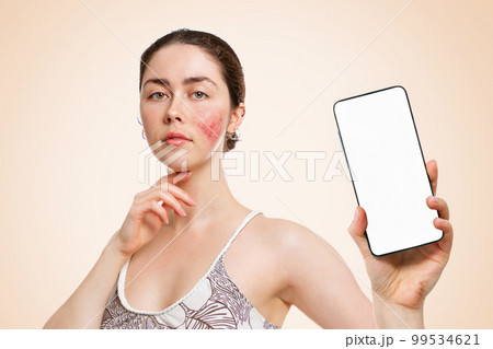 Portrait of a young Caucasian woman, with inflamed red cheeks, holding a smarfton in her hand.Mock up and copy space.Beige background.Concept of rosacea, health care and rosacea 99534621