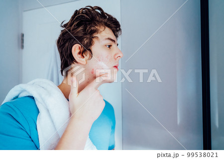 Concentrated caucasian teenage boy with acne problem take care his face skin at home. He looking in mirror and aplying cream on the face in bathroom. Teenager skin care every day treatment process 99538021