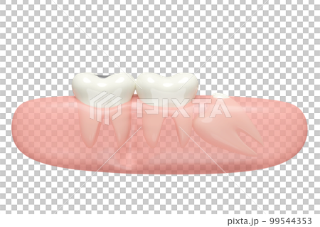 3d wisdom teeth model problems icon with gums isolated. dental examination of the dentist, health of white teeth, oral care, 3d render illustration 99544353